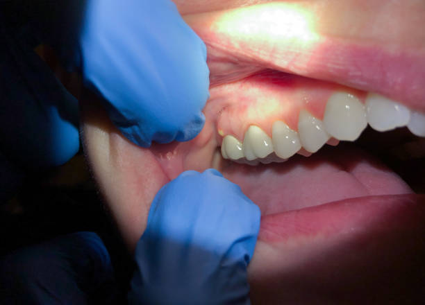 Best Emergency Dentist for Lost Fillings or Crowns in Muskegon, MI